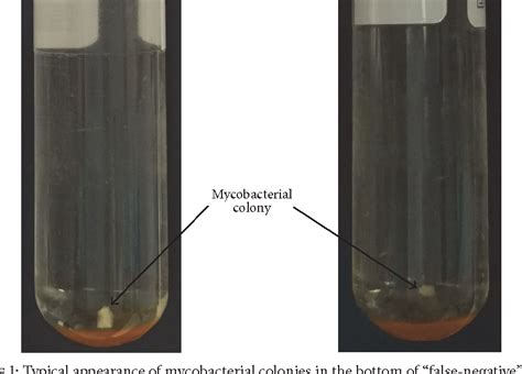 Figure 1 From Factors Associated With Missed Detection Of Mycobacterium