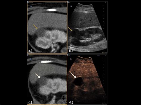 Realtime Sidebyside Image Fusion Of A Patient With A Cortical Renal