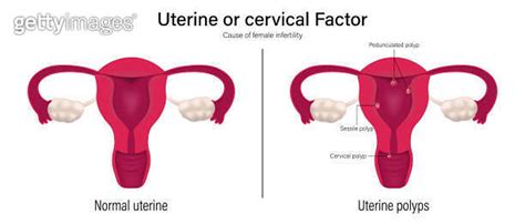 Female Infertility Vector Comparison Of Normal Uterine And Uterine