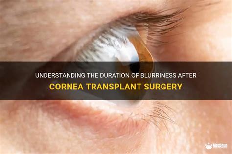 Understanding The Duration Of Blurriness After Cornea Transplant