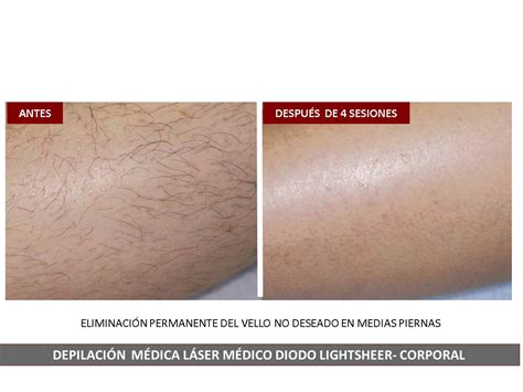 Valores Boxeo Sobre Depilacion Laser Diodo Antes Y Despues Finalizando