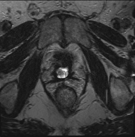 Tulsa Treatment Prostate Ablation Month Post Profound Medical