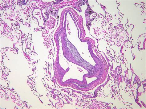 Flickriver Pulmonary Pathology Society S Photos Tagged With Thromboembolus