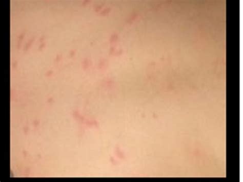 Mysterious Rash Outbreak Continues in Lake Forest, Saddleback USD | Lake Forest, CA Patch