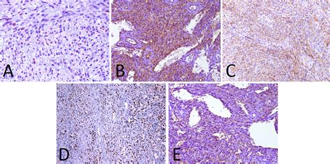 Hiv Positive Patients With Oral Kaposis Sarcoma An Overall Survival