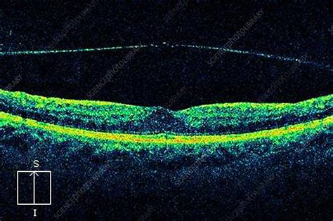 Vitreous detachment of the eye, OCT scan - Stock Image - C024/0943 ...