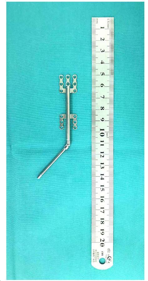 Mandibular distractor. A semiburied unidirectional distraction device ...