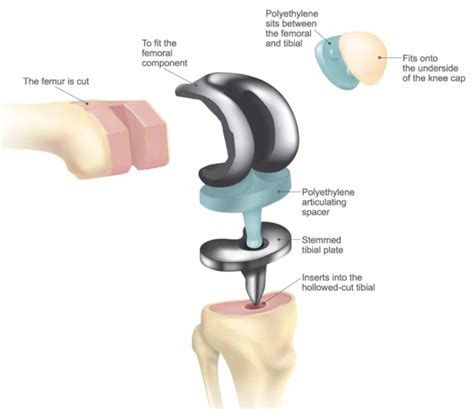 Patient S Guide To Total Knee Replacement Atx Orthopedics