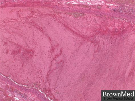 Thromboembolus