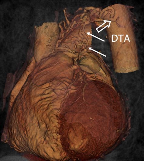 Coronary Artery Fistulas Pathophysiology Imaging Findings And