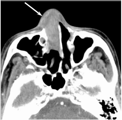 Sinonasal Undifferentiated Carcinoma Of The Right Nasal Cavity