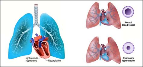 Pulmonary Hypertension A Comprehensive Guide To Understanding And