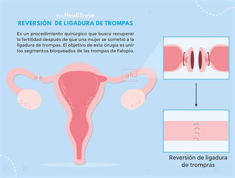 Reversión de ligadura de trompas Gynfertil