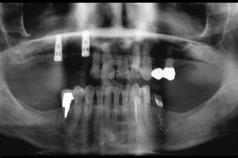 Maxillary Sinus Grafting Fraschini Chirurgia Orale