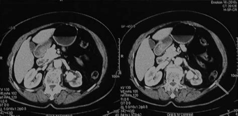 CT Cross Section Slides Showing Large UPJ Stone Thinning Of Left Renal