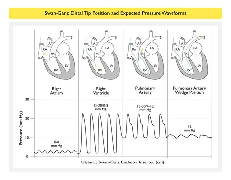 SWAN-GANZ WAVEFORMS4 – MD Nexus