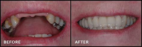 Partial Implant Retained Fixed Bridges | Manningham Dental