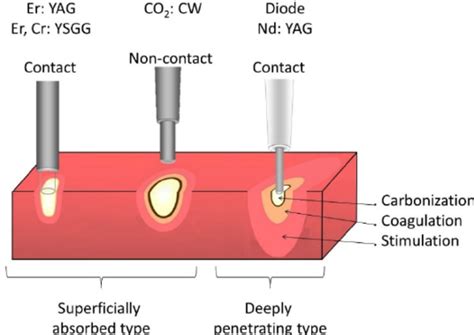 Schematic Representation Of The Classification Of Lasers According To Download Scientific