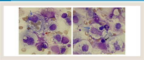 Figure 1 From Diagnostic Challenges Of Hemophagocytic