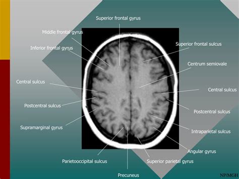 Intraparietal Sulcus Mri