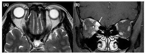 JCM Free Full Text Clinical Features Of Ocular Motility In