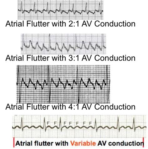 20 Best Atrial Flutter Images Atrial Flutter Flutter Conduction Images