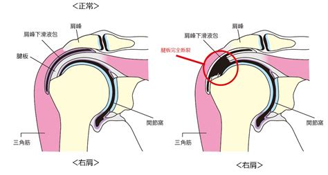 野球肩｜sports Medicine Library｜ザムスト（zamst）