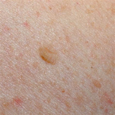 Nevus On The Skin Melanoma Or Cancer Dermatology Stock Image Image