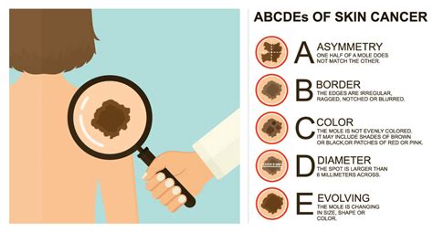 Cancerous Moles Vs Normal Moles