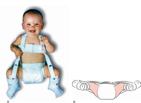 Developmental Dysplasia of the Hip | Obgyn Key