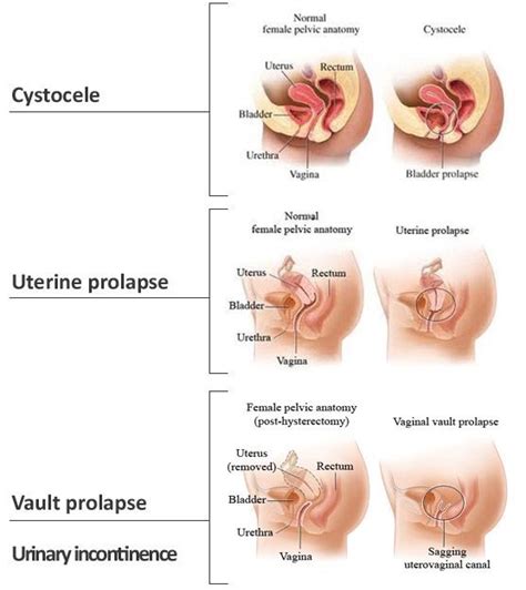 Types Of Pelvic Organ Prolapse Macobgyn Urogyn Prolapse Bladder Prolapse Pelvic Organ