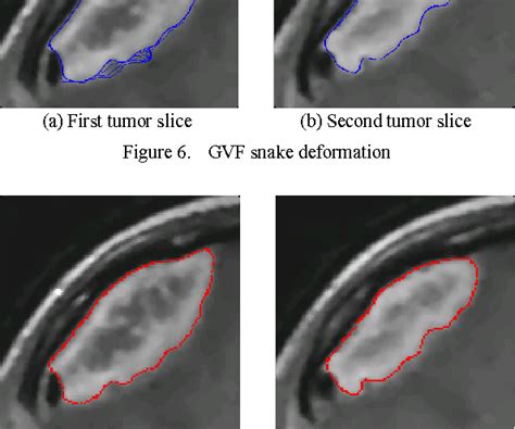 Figure From Medical Image Segmentation Based On Gvf Snake Model