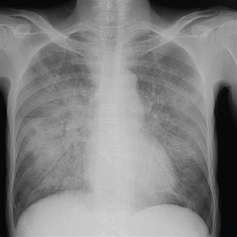 Chest Radiography And Computed Tomography Ct During Hospitalization