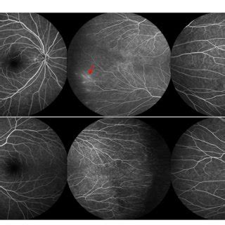 FIGURE E Fundus Fluorescein Angiography FFA Findings Of The Elder