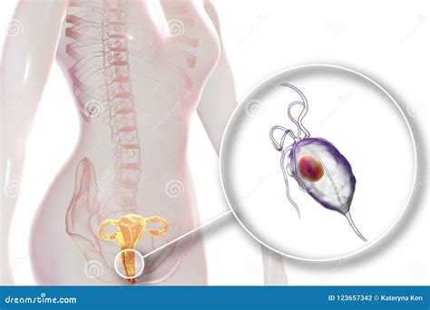 Trichomoniasis Femelle Illustration Montrant Le Parasite De Vaginalis