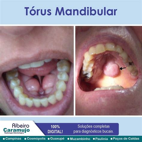 O Que É Torus Mandibular - Ribeiro - Tórus mandibular é um crescimento ósseo protuberante ...