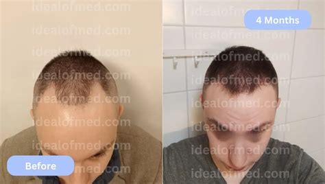 Hair Transplant Results After 2 Months Before After Images