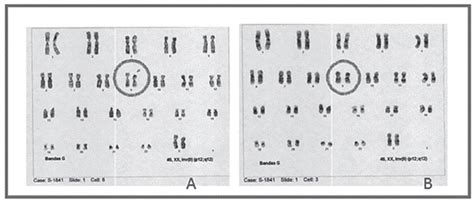 Reporte De Casos De Inversi N De Cromosoma En Una Muestra De