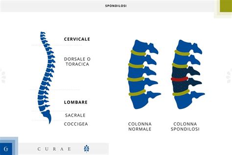 Spondilosi Tipologie Sintomi Cause Diagnosi E Percorso Di Cure