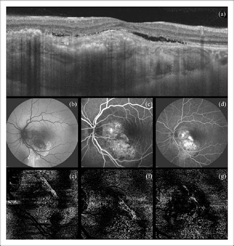 Figure From Choroidal Neovascularization Due To Choroidal Osteoma