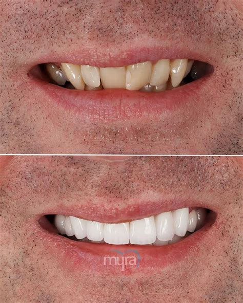 Narrow Smile Definition Causes And How To Fix It