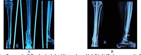 Management Of Distal Tibial Metaphyseal Fractures By Expert Tibial Nail