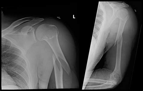 Humerus Fracture X Ray