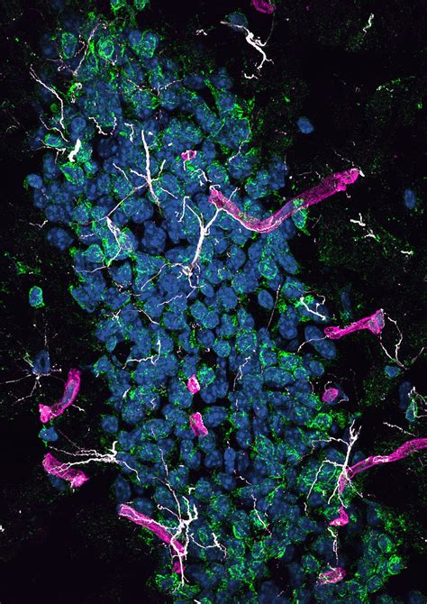 Protein from the liver may cause Alzheimer's disease in the brain