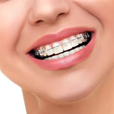 Braces Vs Invisalign Choosing The Right Orthodontic Treatment