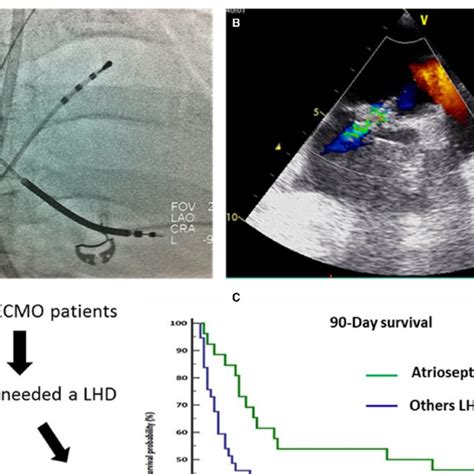 Central Illustration Percutaneous Balloon Atrioseptostomy Realization