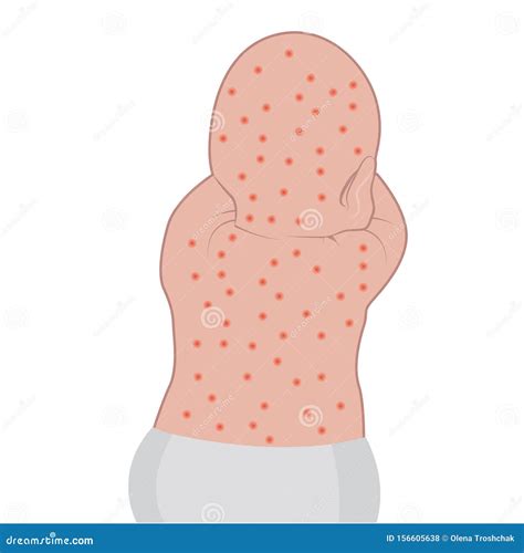 Baby`s Back Affected with Eczema Skin Stock Vector - Illustration of human, affected: 156605638