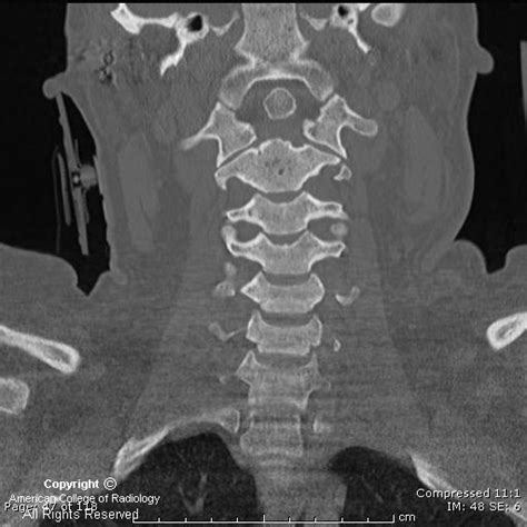 Neuroradiology On the Net: Os Odontoideum