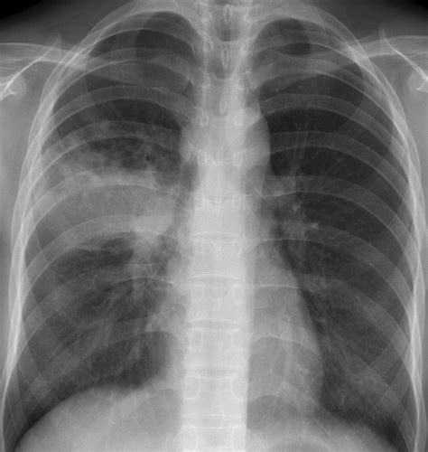 Pulmonary Tuberculosis Up To Date Imaging And Management Ajr