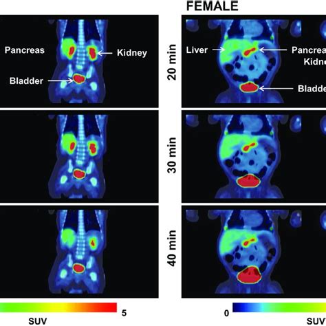 18 F Fluoro L DOPA PET CT Scan Showing The Focal And Diffuse Uptake